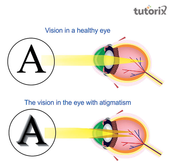 Application of Toric lens