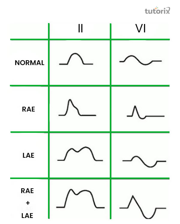 Atrial Hypertrophy [P Wave]