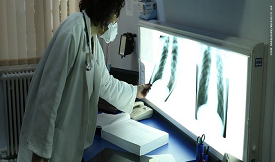 Tuberculosis