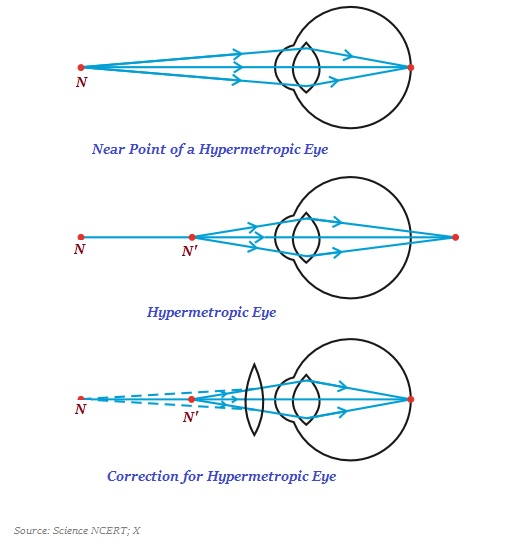 Hypermetropia