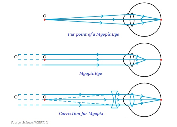 Myopia